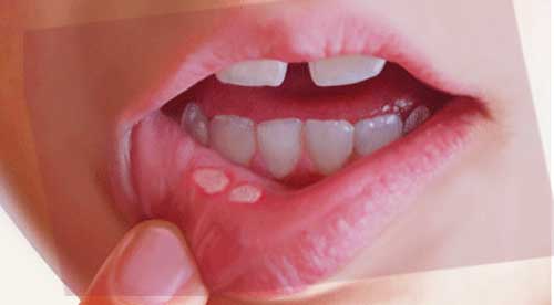 Cure Canker Sore Fast